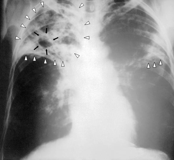 В 2010 году в Харькове зарегистрировано 615 больных туберкулезом органов дыхания.  Фото ru.wikipedia.org.