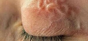 Укусил комар: харьковчанка вытащила из глаза 12-сантиметрового паразита