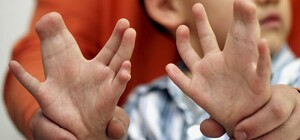 Родился с патологией: в Днепре врачи разделили сросшиеся пальчики малыша (фото)