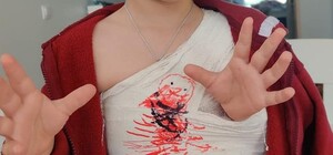 Перелом ключицы и гематома: в киевском 