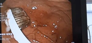 Врачи ОХМАТДЕТа вытащили зубную щетку из желудка девочки: уже третий случай за год