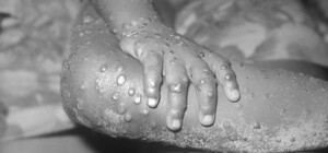 В Минздраве рассказали, как передается обезьянья оспа и какие симптомы