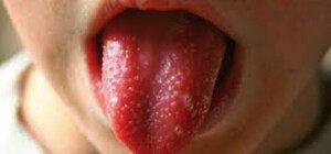 В МОЗ уточнили, есть ли в Киеве вспышка скарлатины