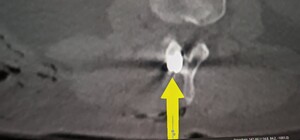 В Александровской больнице провели редкую операцию по извлечению из позвоночника обломка ракеты - фото