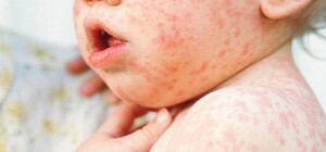 В Одесской области зафиксированы новые случаи кори, один из которых летальный