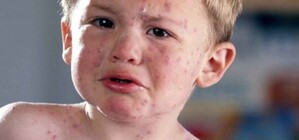 В Луганской области стали чаще болеть ветрянкой и скарлатиной