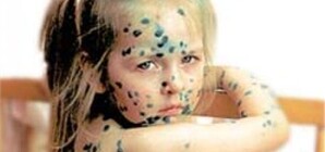 Закрывать сады и школы из-за ветрянки одесские санварчи не собираются