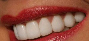 Два способа отбеливания зубов дома: дешево и эффективно