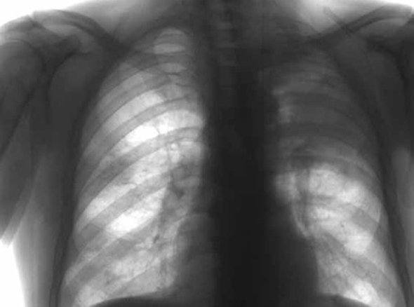 «Залог успеха» лечения туберкулеза лежит именно в его ранней диагностике. 
