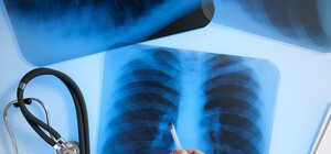 Туберкулезный скандал с педиатром в Одессе: почему не заметили болезнь и что говорят родители