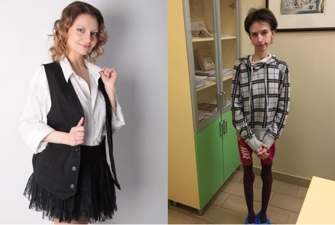 В Харькове нуждается в помощи девушка с анорексией, которая вести 23 килограмма. Фото: соцсети