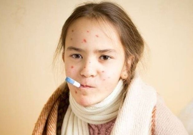 На Харьковщине за неделю стало на 20 заболевших корью больше. Фото: hochu.ua