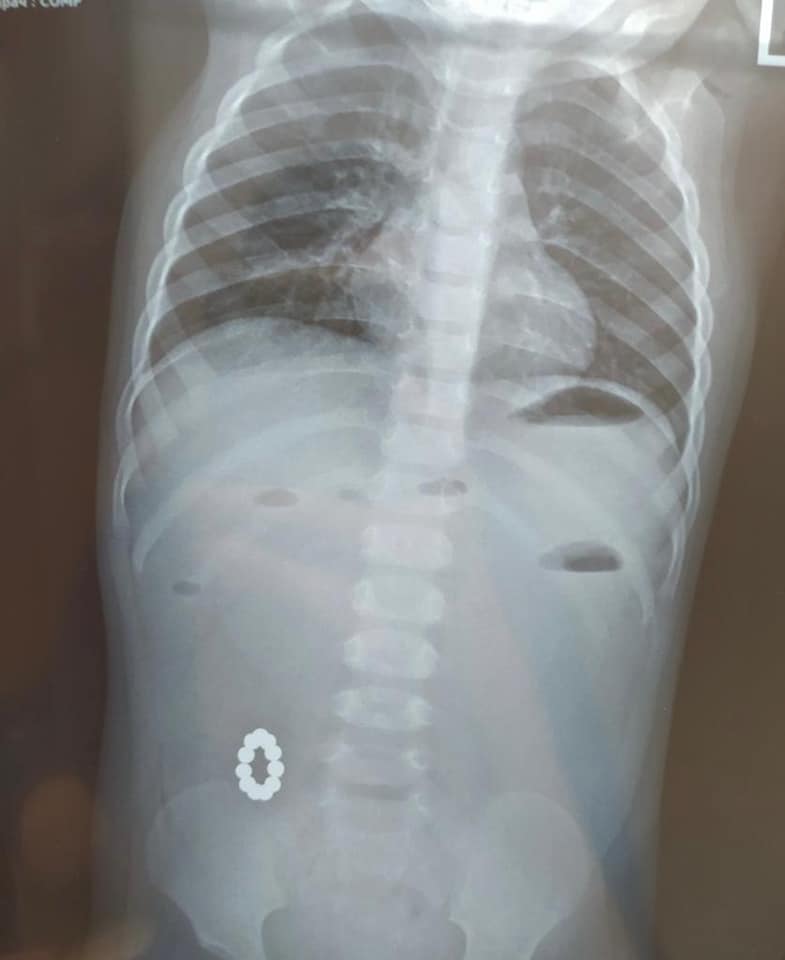 В Харькове годовалый ребенок проглотил 11 магнитов.