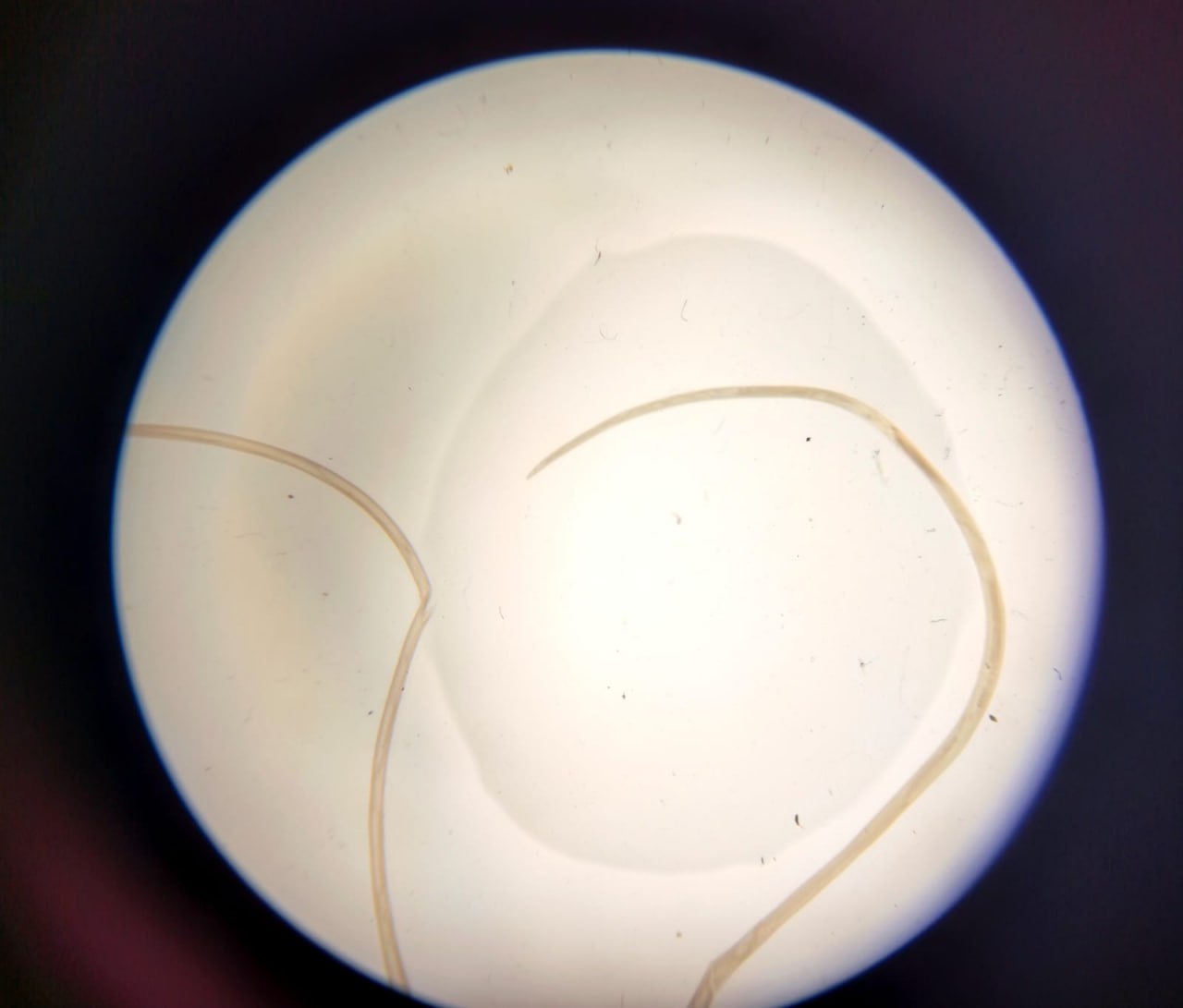 У жительницы Запорожья врачи обнаружили под кожей ужасного паразита.