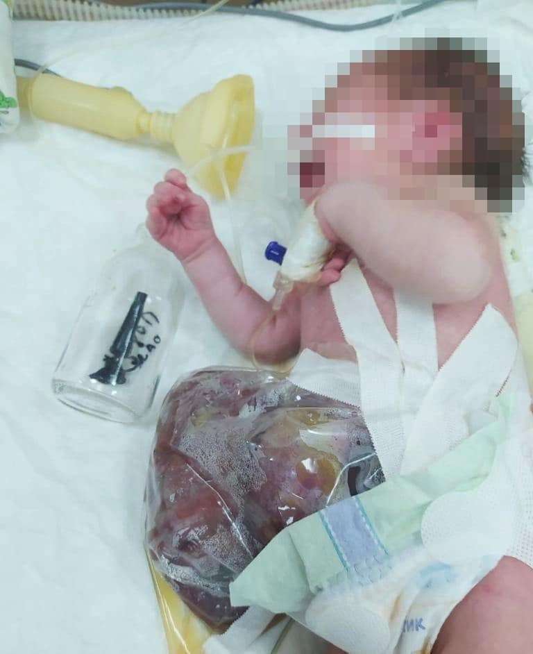 Родился без живота: в Харькове спасают уникального малыша фото 1