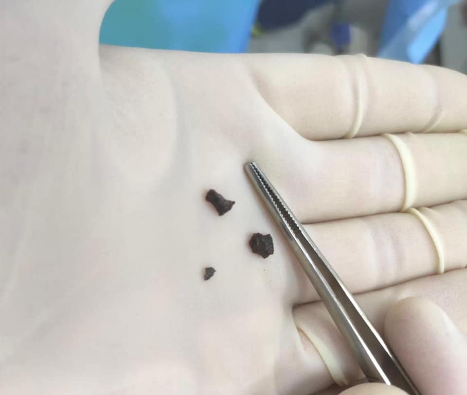 Попали под обстрел на остановке: сестру погибшего 13-летнего Димы Кубата прооперировали.